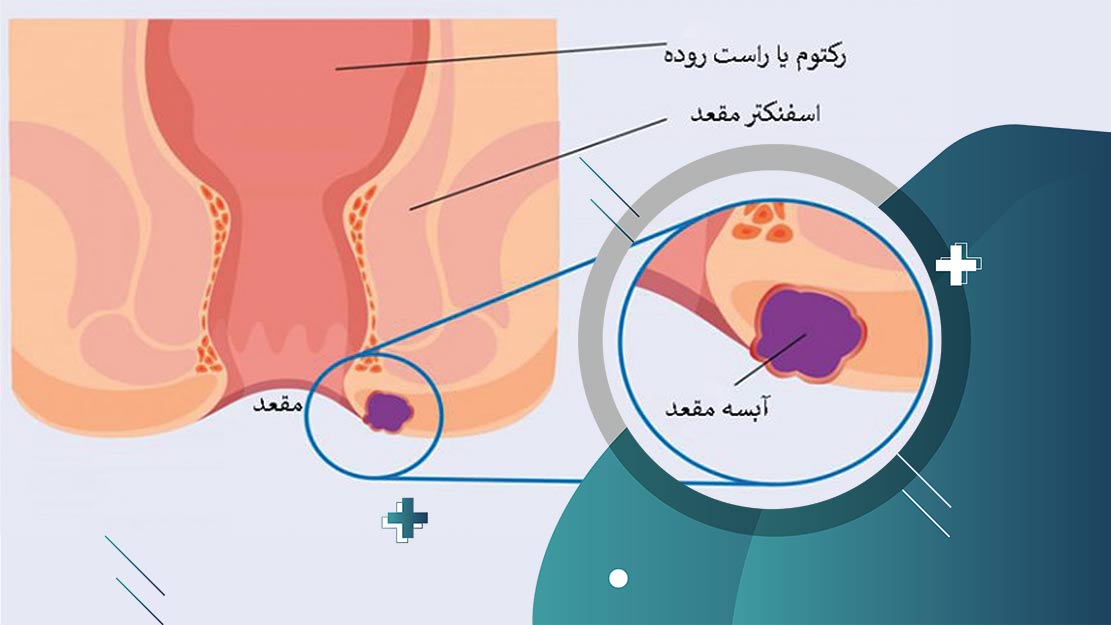 این بیماری یکی از بیماری های ناحیه نشیمنگاهی است که با درد اطراف مقعد بروز میکند. بهترین فوق تخصص جراحي کولورکتال