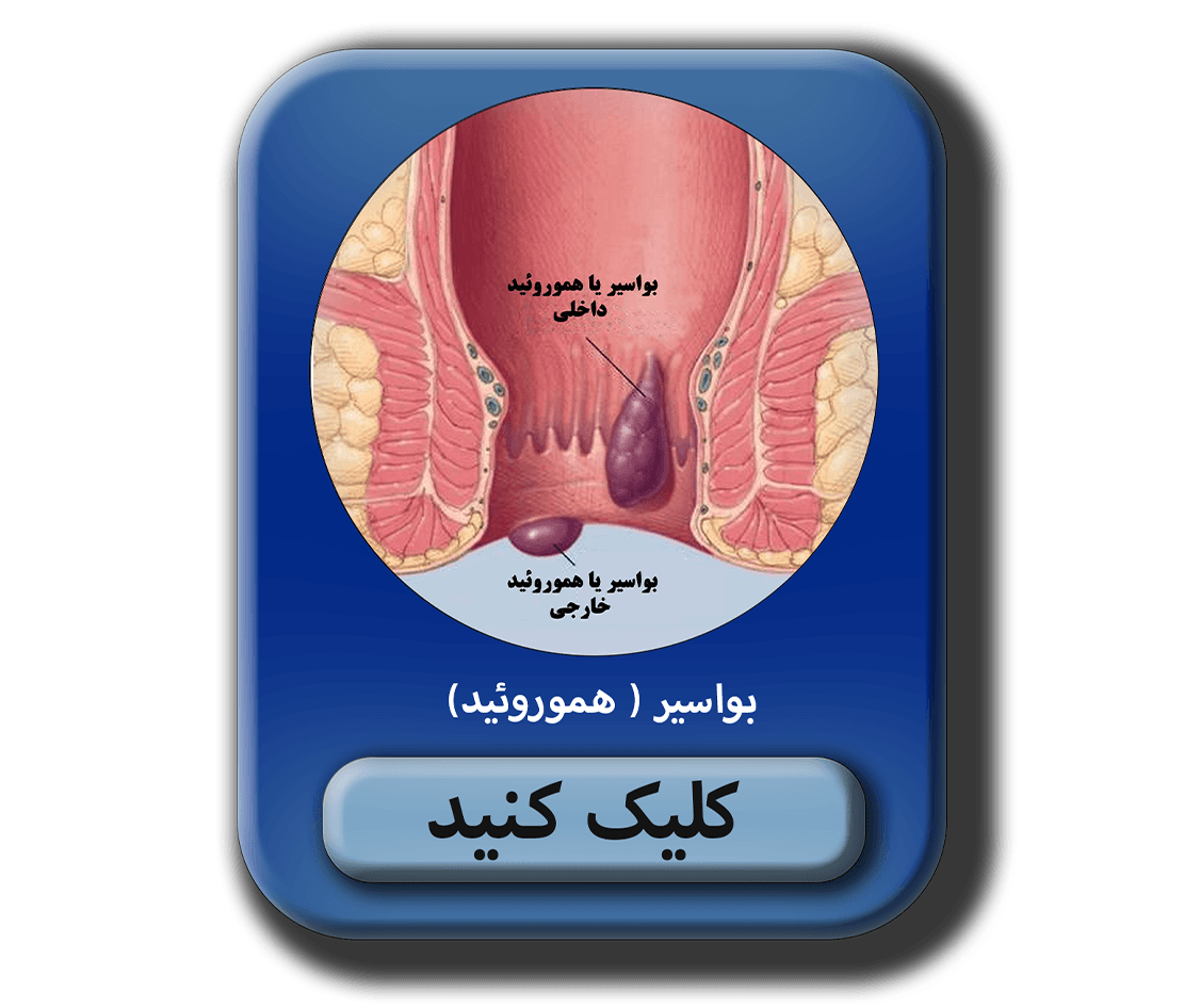 بيماري هموروئيد ( بواسير ) به دو دسته داخلي و خارجي تقسيم مي شود. مطلب در مورد بواسير ( هموروئيد)