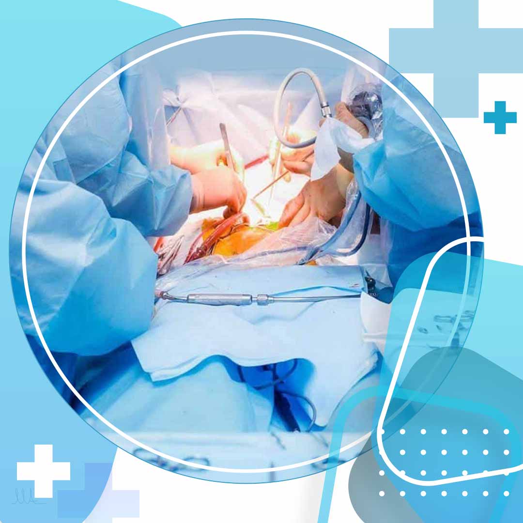 کولکتومی جامع یا کامل که در اون کل روده برداشته می شه انواع جراحی کولکتومی روده
