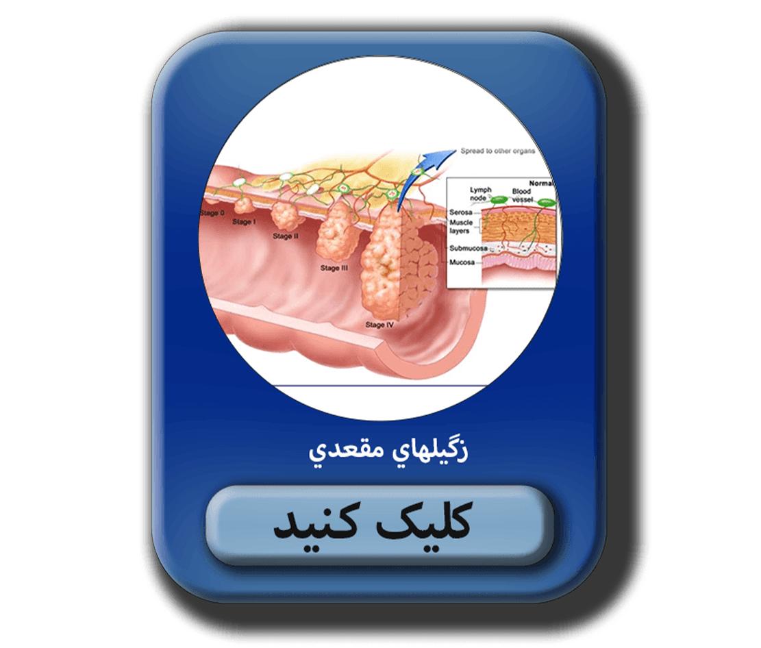 مطلب در مورد زگیلهای مقعدی