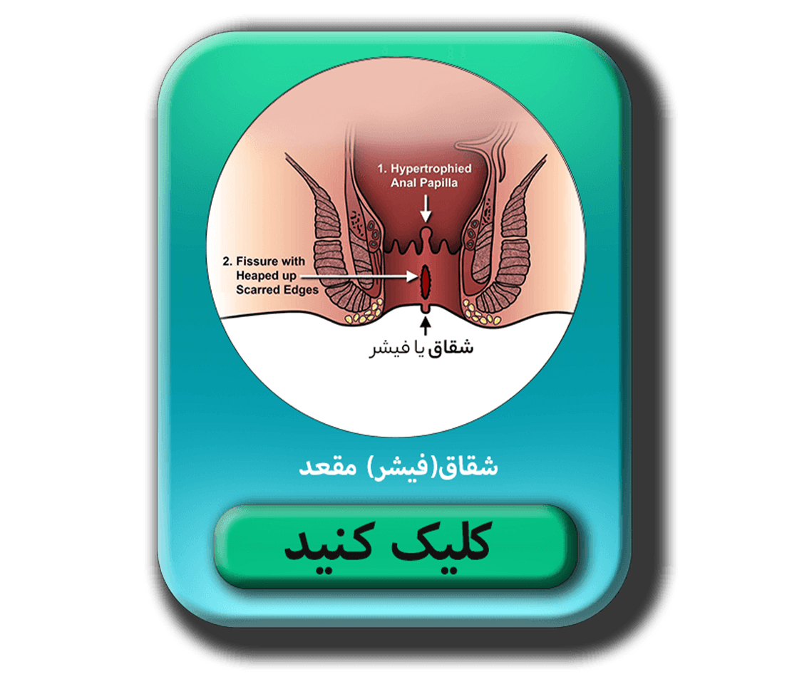 شقاق مقعدی یا فیشر (Anal Fissure) به پارگی یا ایجاد یک شکاف کوچک در مجرای مقعدی گفته میشود مطلب در مورد شقاق مقعد (آنال فيشر )
