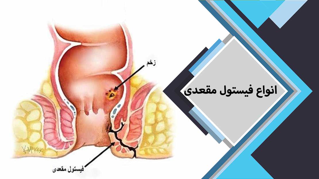 بهترین فوق تخصص جراحي کولورکتال 