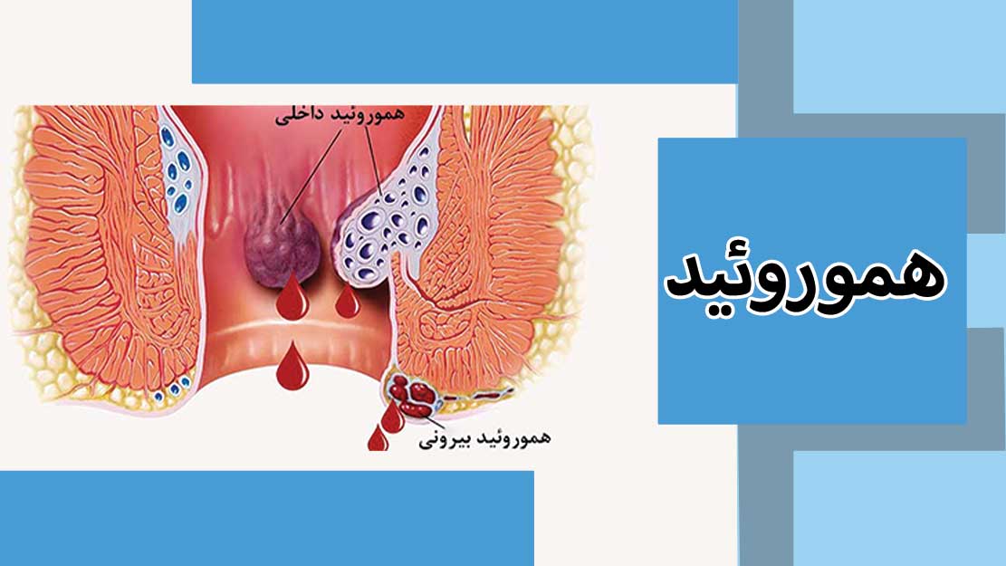 همورویید ها ، عروق کوچکی هستند که در مقعد تمام انسان ها و به طور طبیعی وجود دارند. بهترین فوق تخصص جراحي کولورکتال